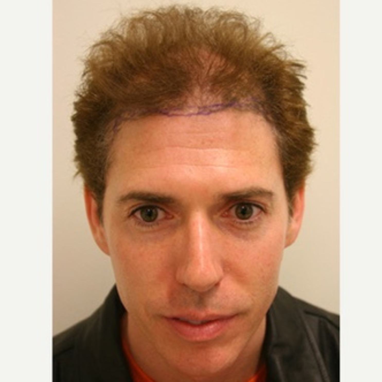 Hair Transplant